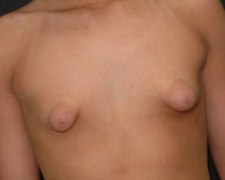 Puffy And Malformed Tits Lovely Areolas Plastic Surgery Adult Photos