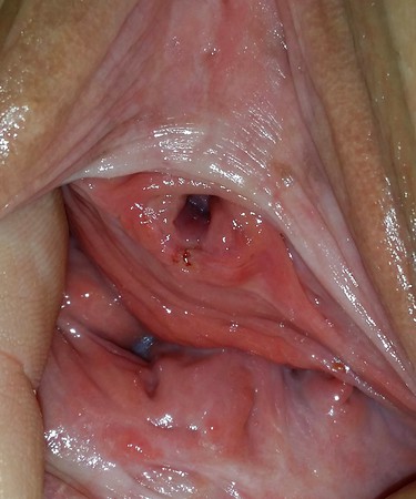 Peeholesex Urethra Porn