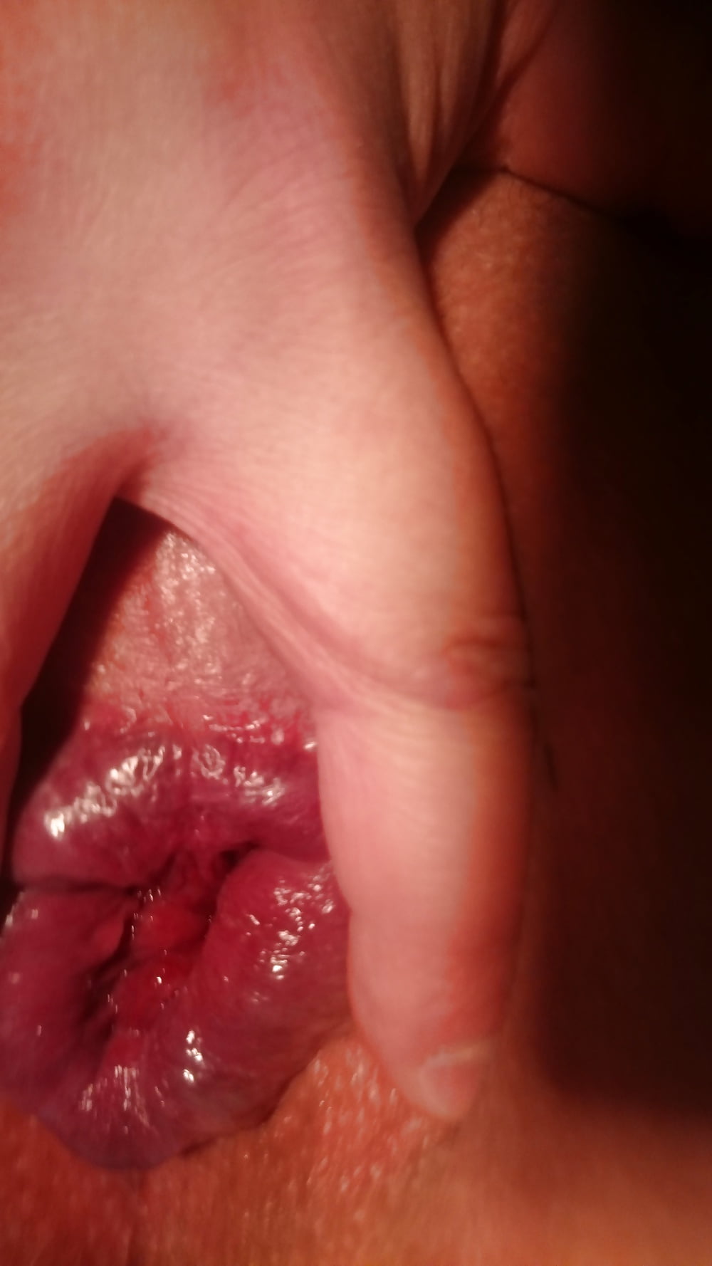 Bumhole (light prolapse) adult photos