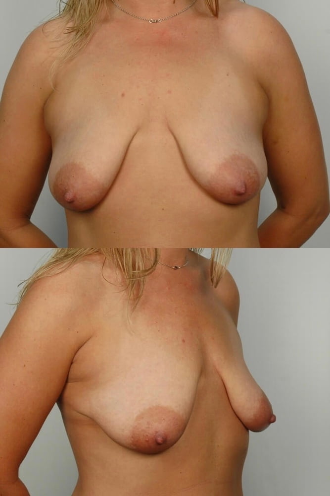 Breast reduction surgery after mastectomy-2203