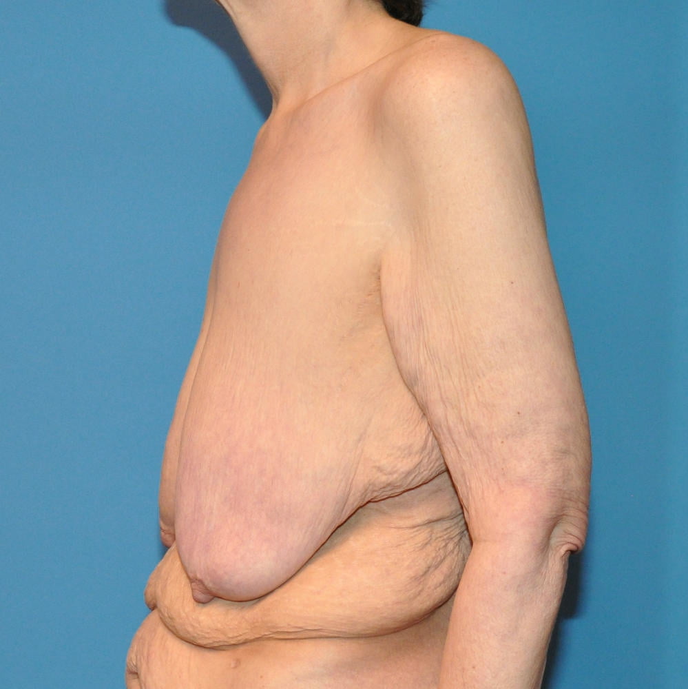 Super Saggy Tits Breast Reduction 2 Pics Xhamster 4159