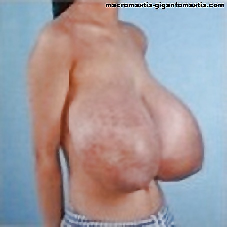 daftsex-hd.com Breast Breast Gigantomastia Hyperplasia Hypertrophy Macromas...
