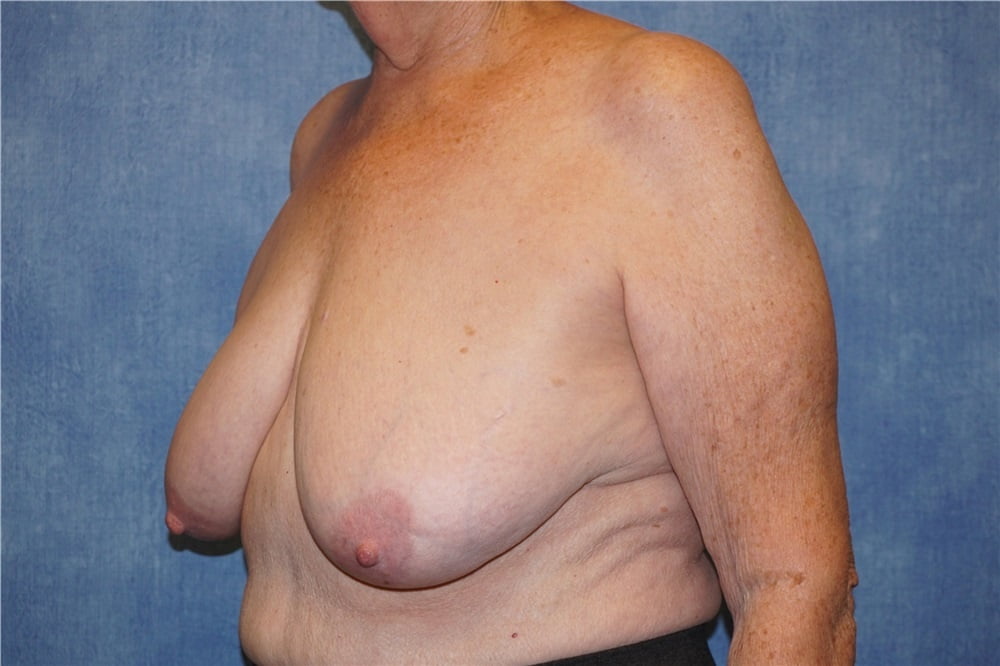 Top plastic surgeons for breast reduction-9346