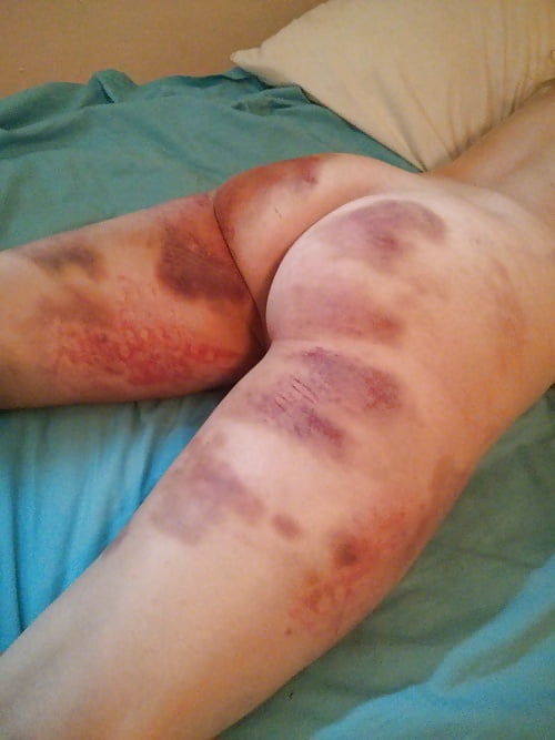 Bruises 14 Pics